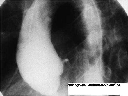 phoca_thumb_l_11-aortografia-anuloectasia-aortica