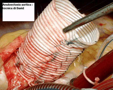 phoca_thumb_l_20-anuloectasia-aortica-tecnica-di-david
