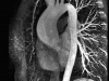 phoca_thumb_l_10-rmn-aneurisma-aorta-ascendente-2